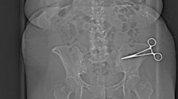 Viene operata, ma il chirurgo dimentica le forbici nell'addome. Scatta la denuncia